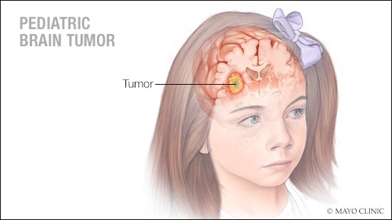 Pediatric Brain Tumor